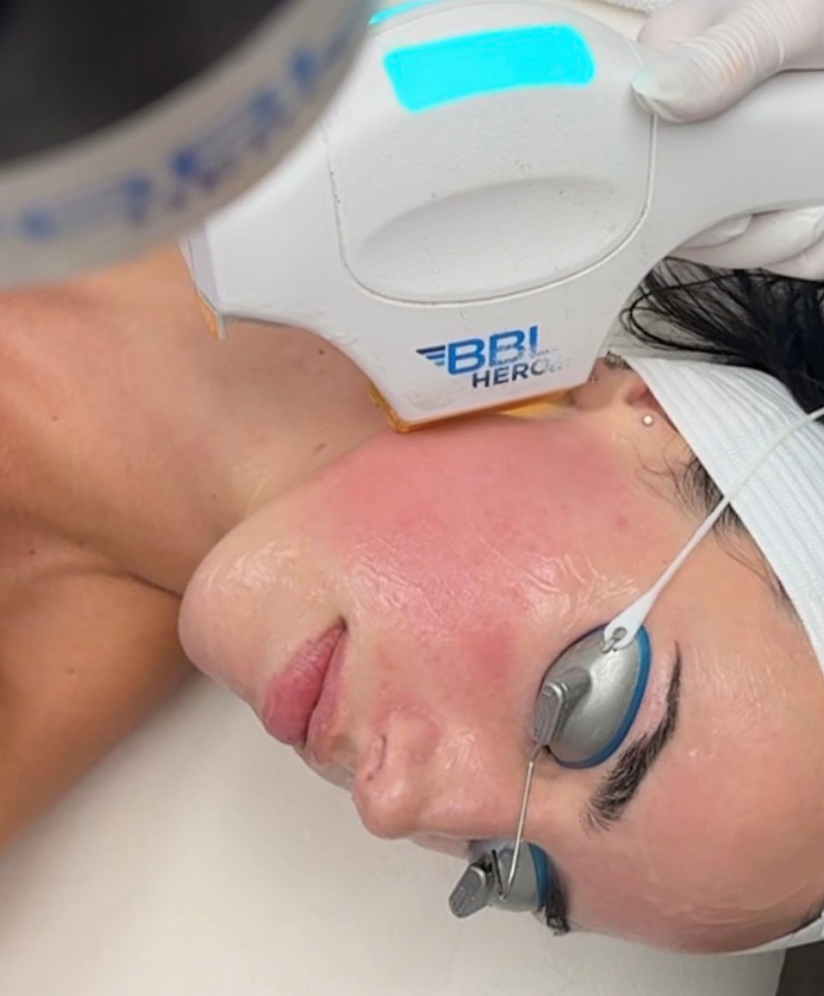 Salt Lake City laser treatment model session with facial device in use.