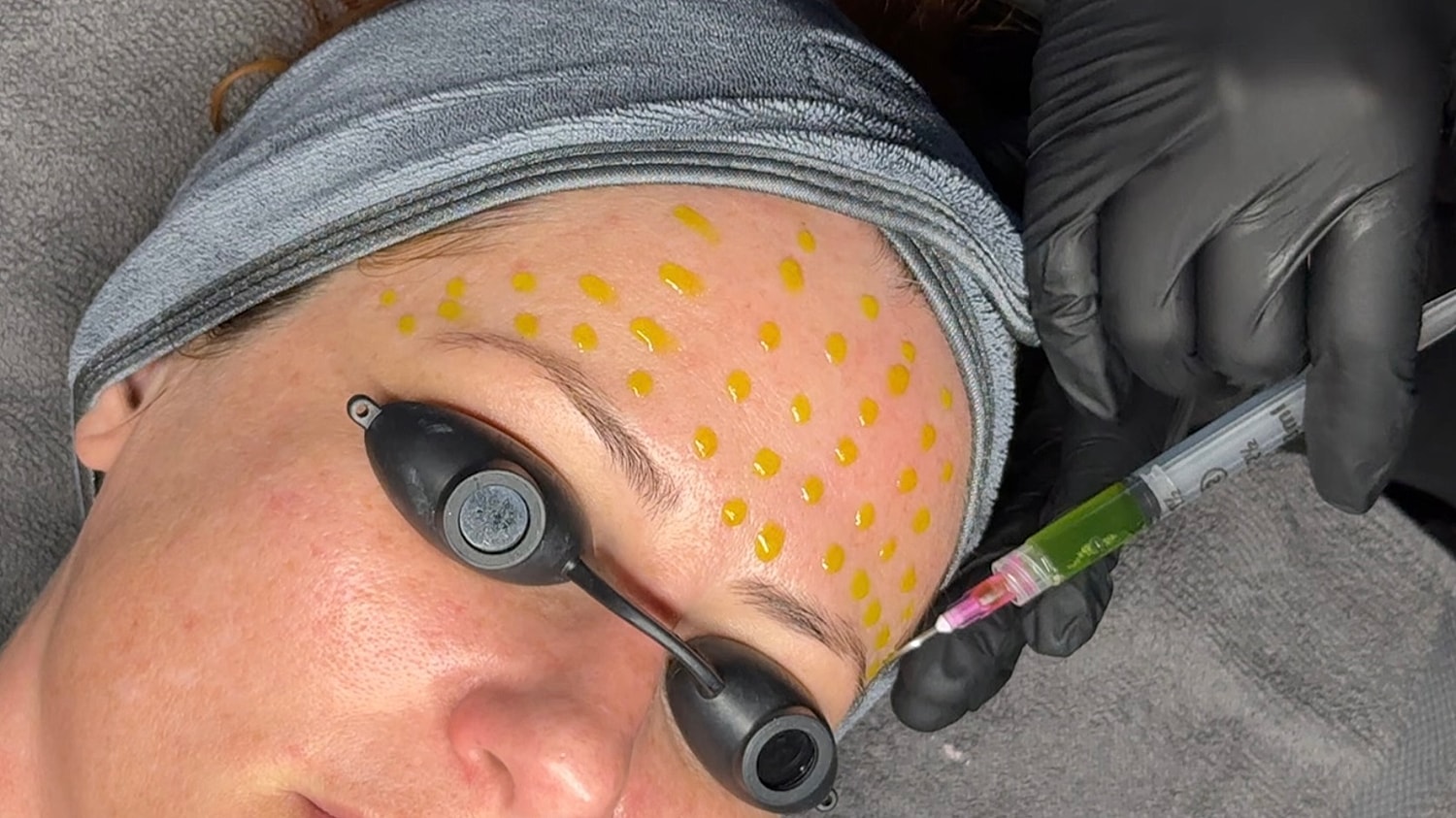 Salt Lake City chemical peel model getting a BioRePeel