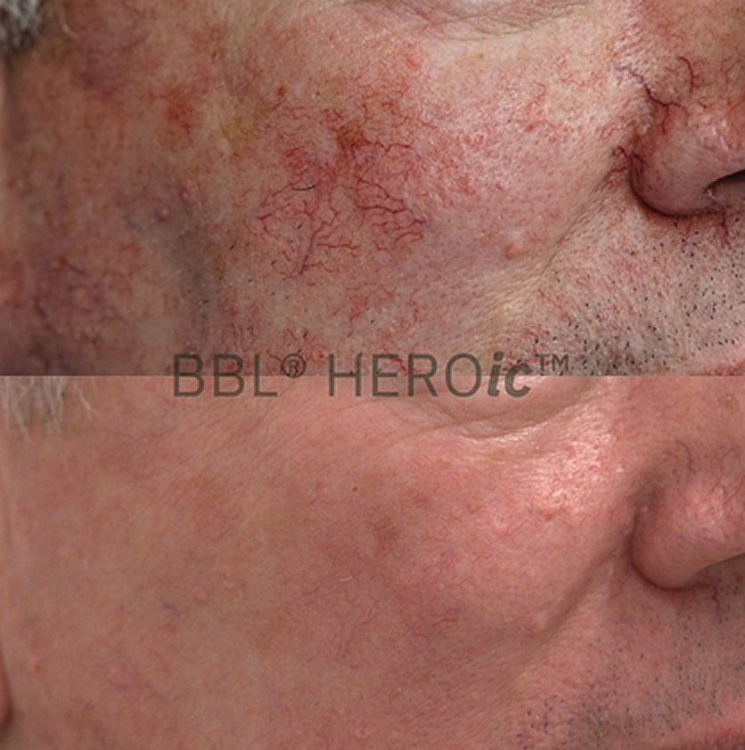 Before and after skin treatment comparison in Salt Lake City.