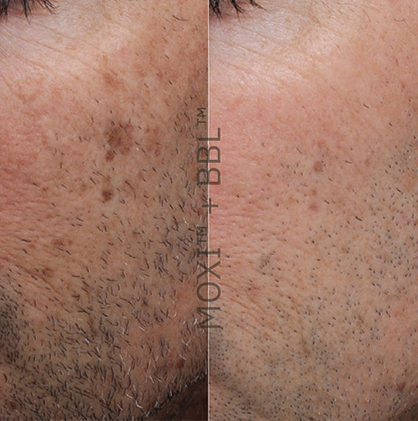 Skin treatment results comparison before and after in Salt Lake City.
