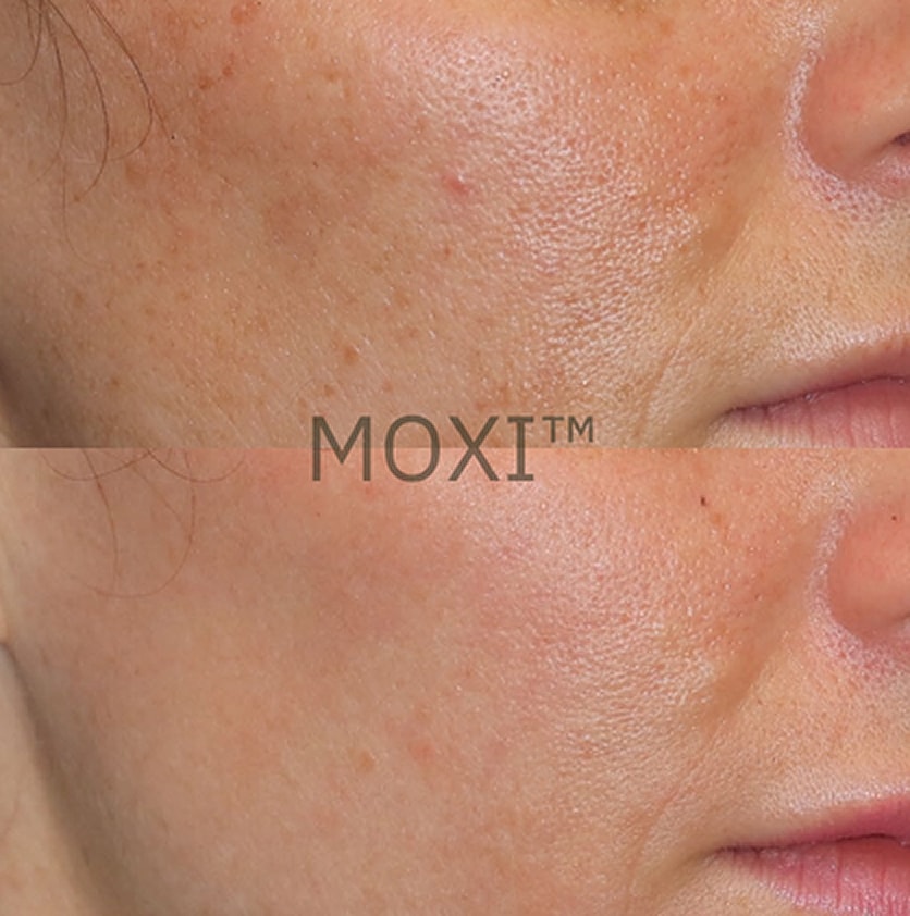 Before and after skin treatment comparison in Salt Lake City.