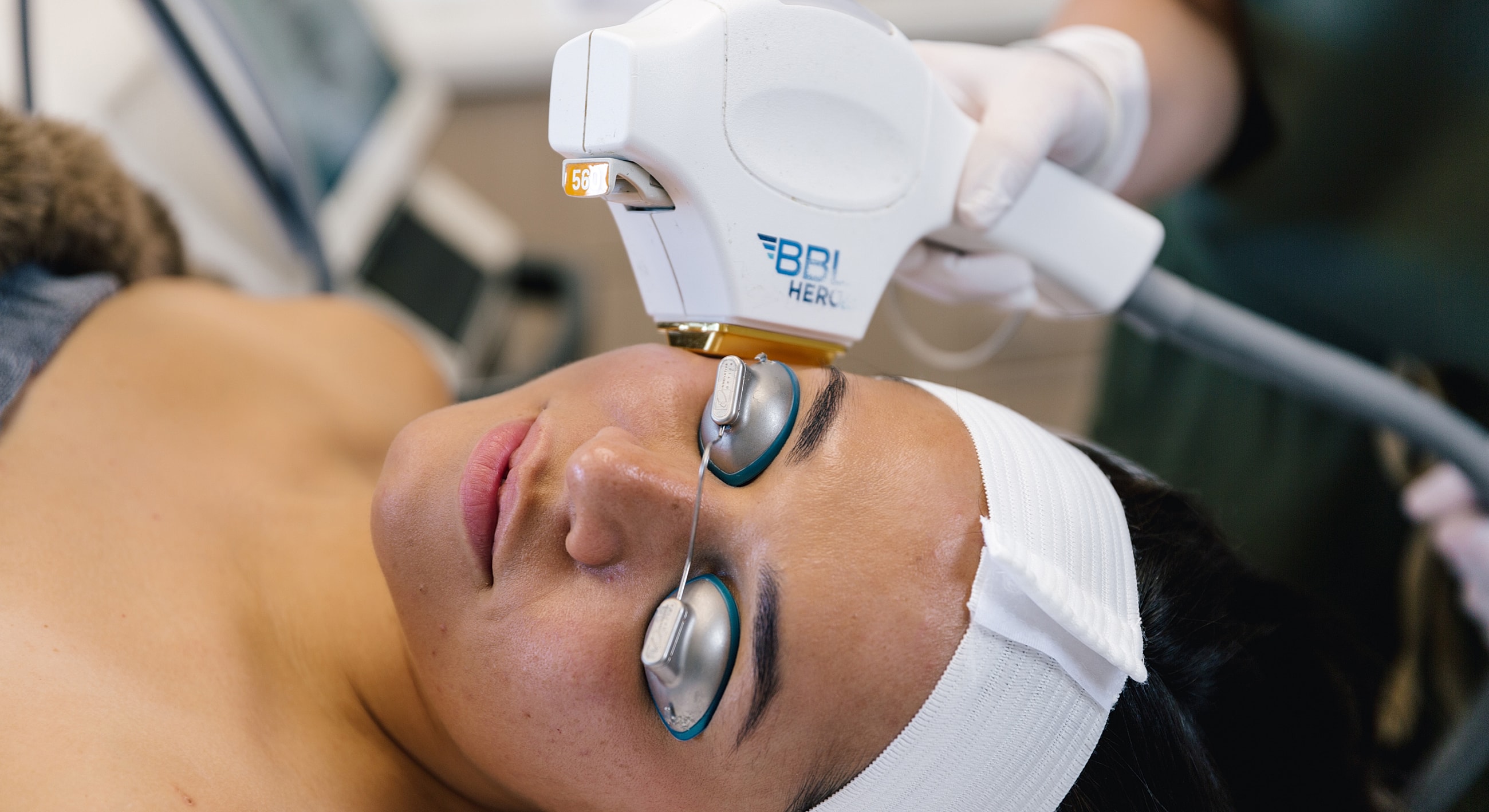 Salt Lake City BBL HEROic laser treatment model receiving treatment with laser device.