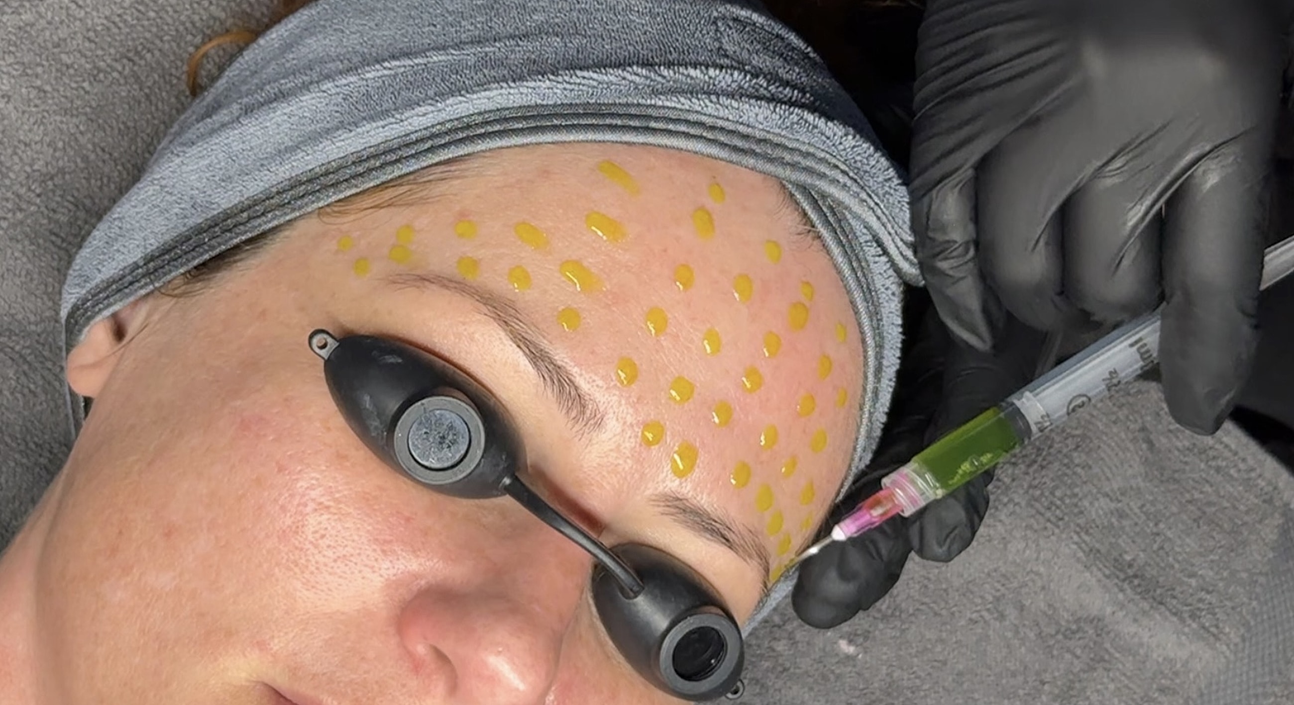 Salt Lake City BioRepeel model receiving facial treatment with micro-needling.